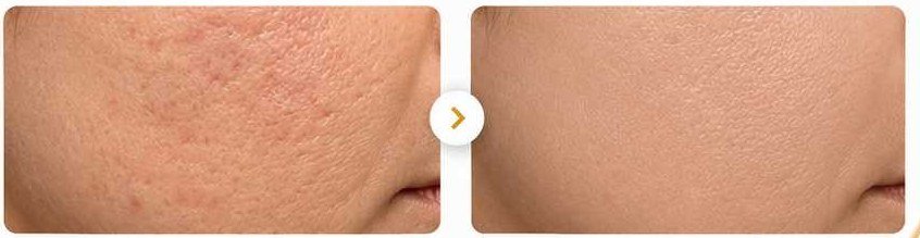 Antes e depois — cicatrizes de acne